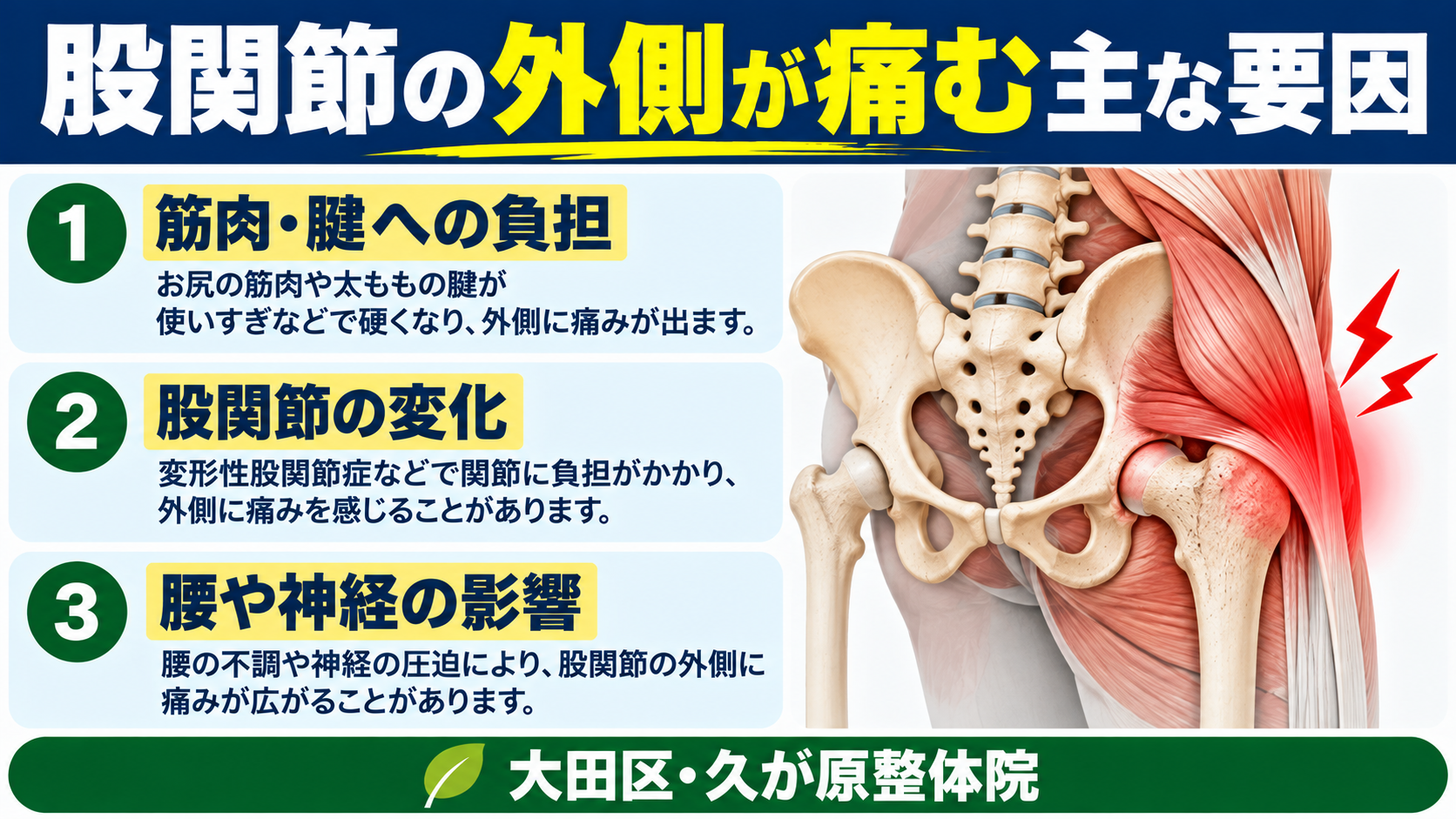 股関節の外側が痛む主な要因として、筋肉や腱への負担、股関節の関節変化、腰や神経の影響を示す図解